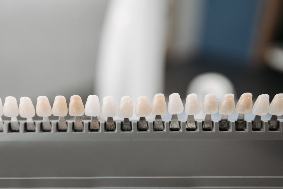 Composite Veneers Türkei: Erfahrungen, Kosten und Ablauf 2026